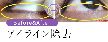 アイライン除去 ビフォー&アフター