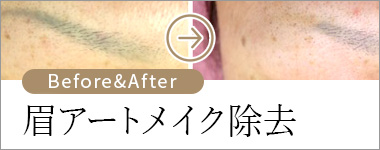 眉アートメイク除去 ビフォー&アフター
