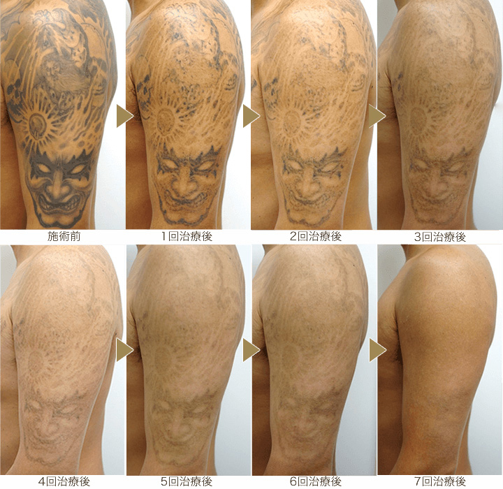 タトゥー除去ピコレーザー ピコレーザーラボ 美容外科 皮膚科 婦人科形成のルーチェクリニック