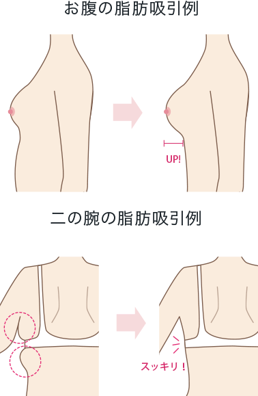 痩身 ダイエット ボディメイクなら脂肪吸引の ルーチェクリニック